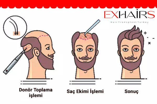 saç-ekimi-nasil-yapilir1